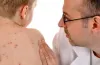 спалах, кір, епідемічна ситуація